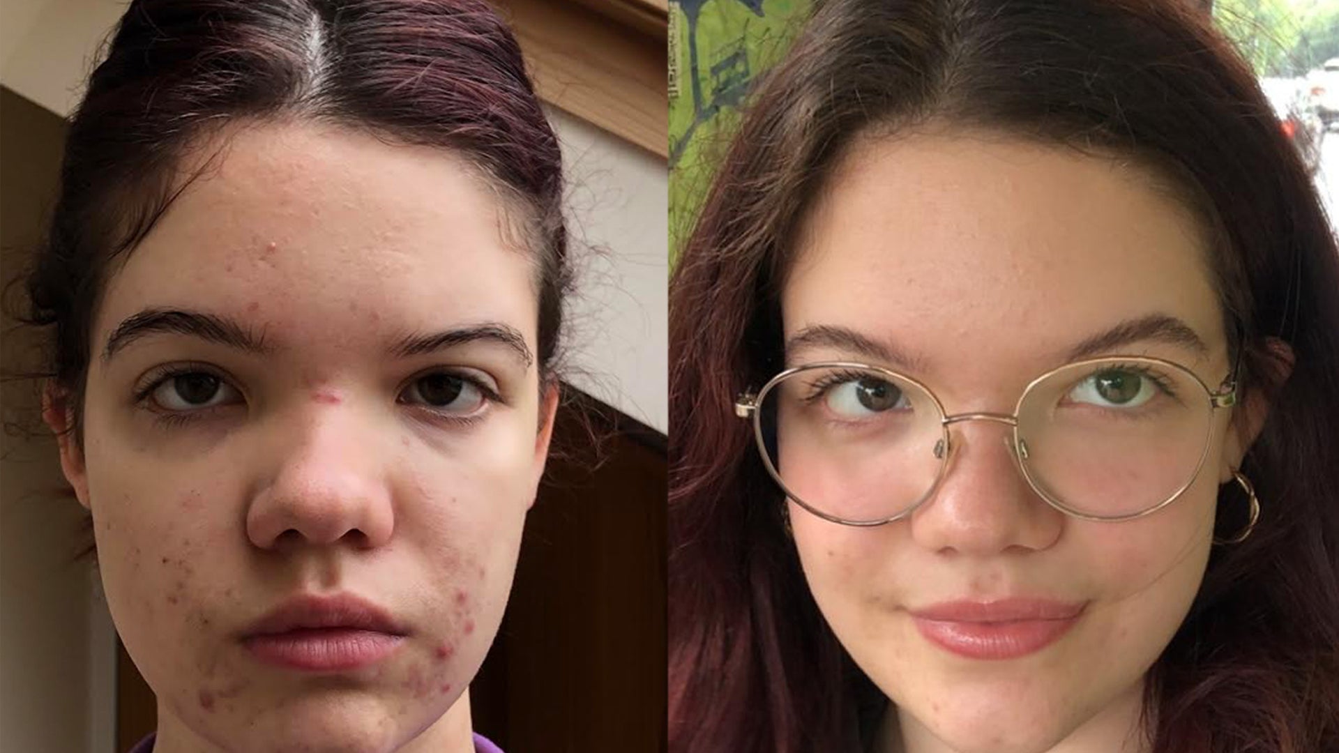 How can you get rid of blemishes on the face for good?