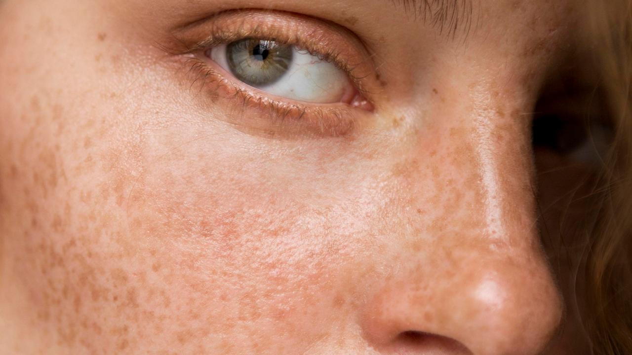 National Rosacea Awareness Month