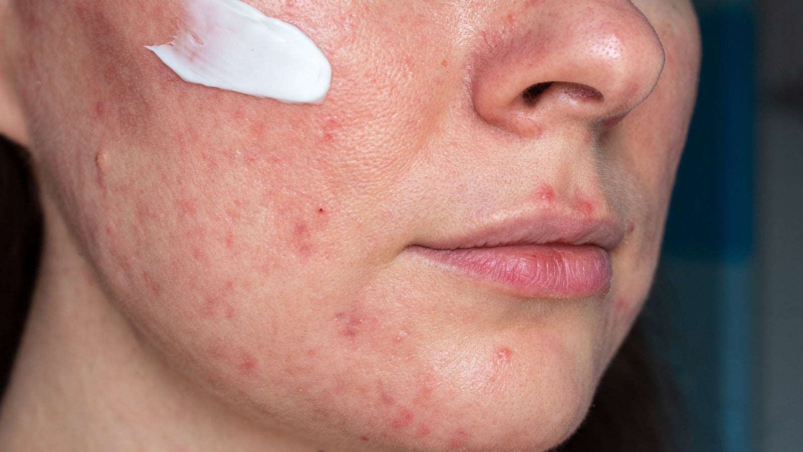 "I Tried Everything for My Rosacea”