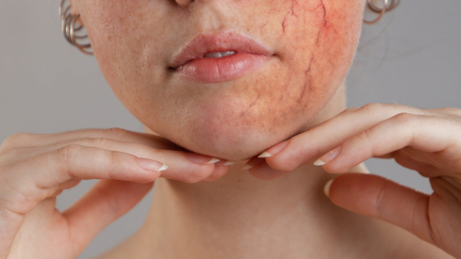 Debunking Rosacea Myths: What You Need to Know