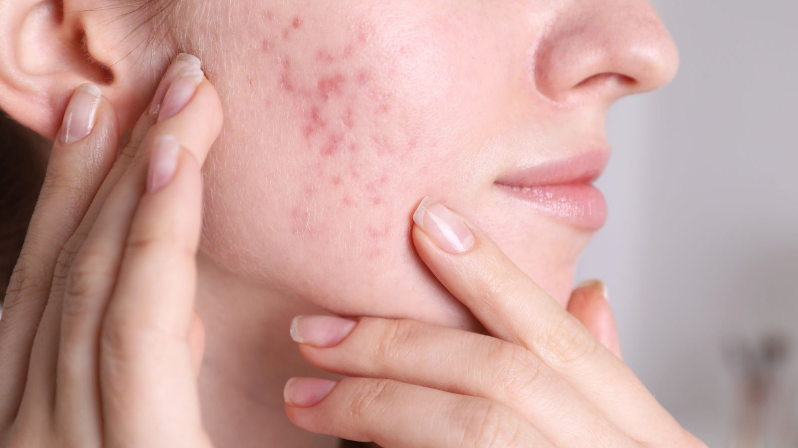 Why Inflammation Is Behind Most of Your Skin Concerns and What to Do About It