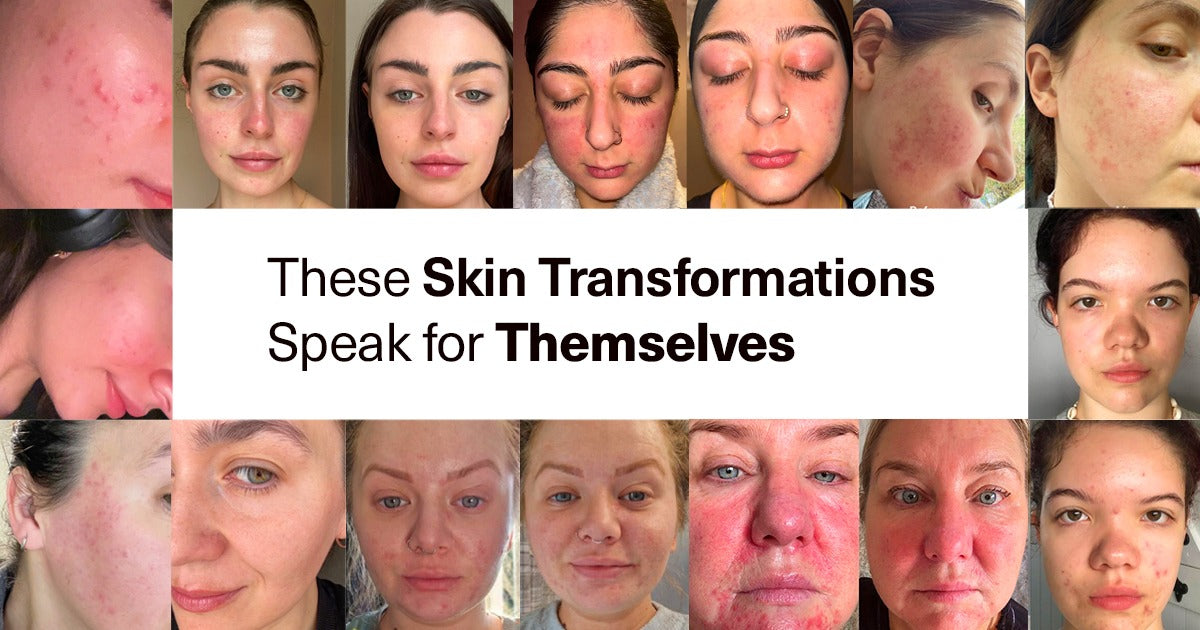 3 Real Skin Journeys with Seacra