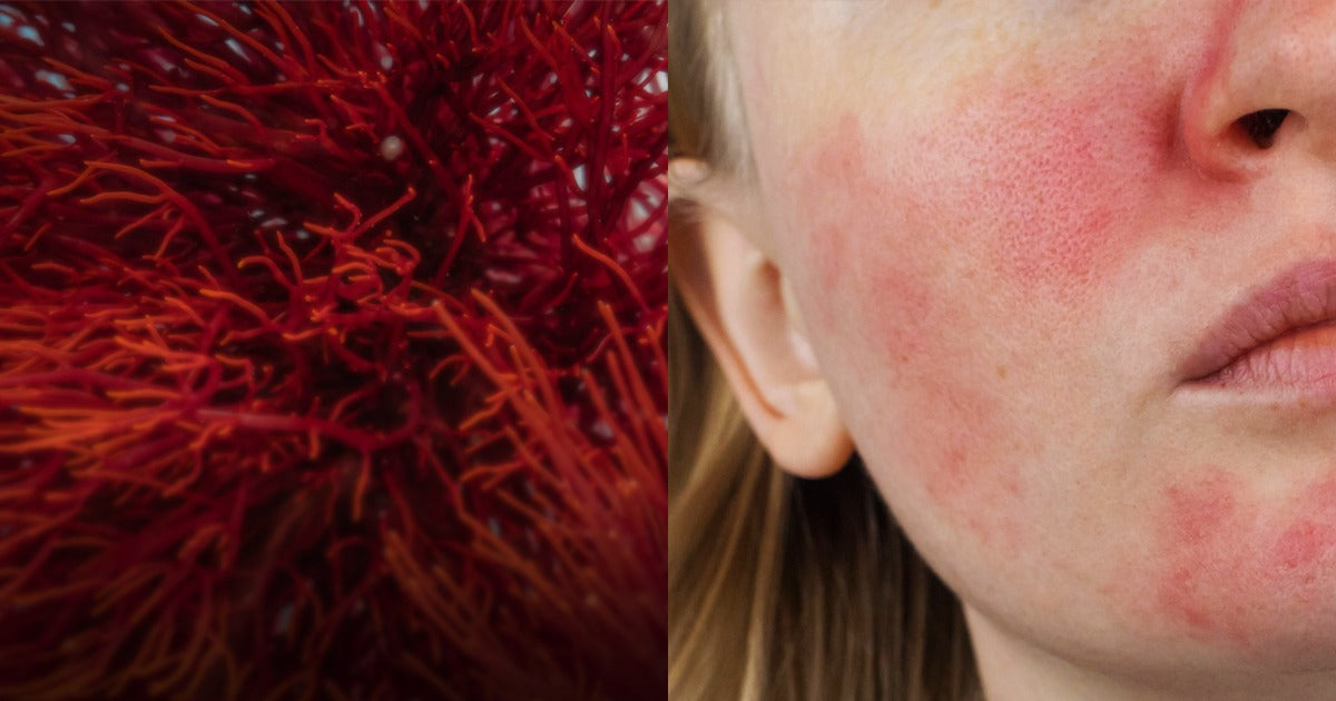 Why Your Moisturiser Might Be Making Your Redness Worse (And What To Use Instead)