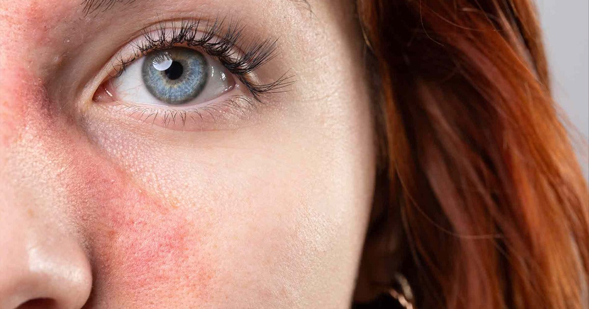Why Sensitive and Rosacea-Prone Skin Reacts to Everything and How to Fix It