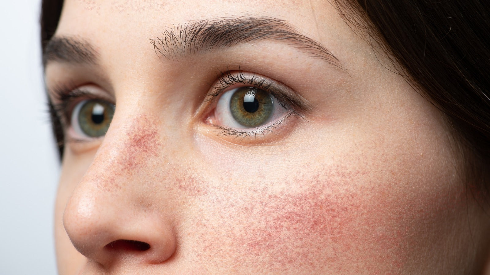 Why Most Skincare Fails Rosacea-Prone Skin (And What Actually Works)