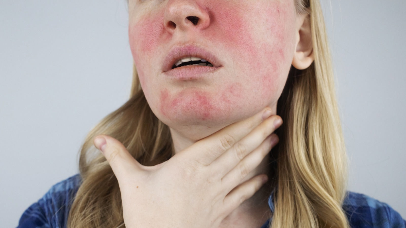 Top 7 Common Mistakes People with Rosacea Make (and How to Fix Them)