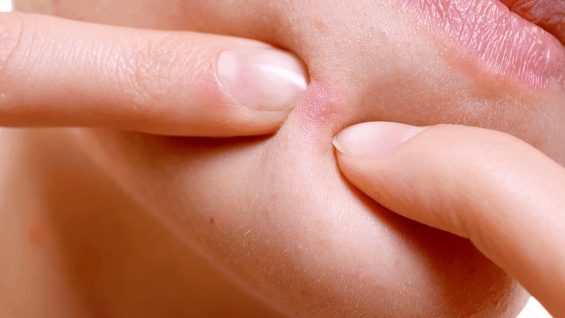 Acne, Blemishes, Pimples and Popping