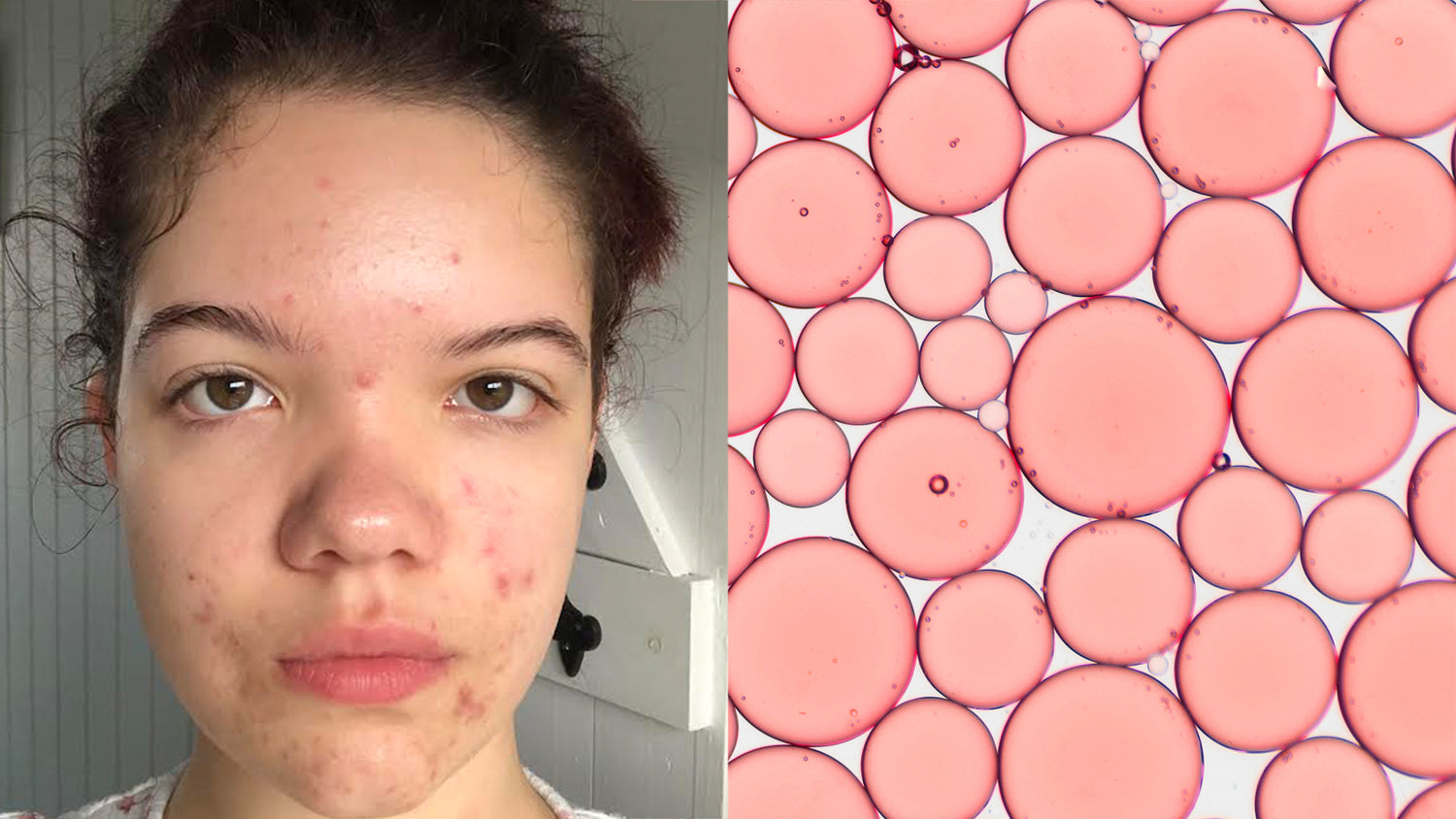 How to get rid of Acne by repairing the skin barrier