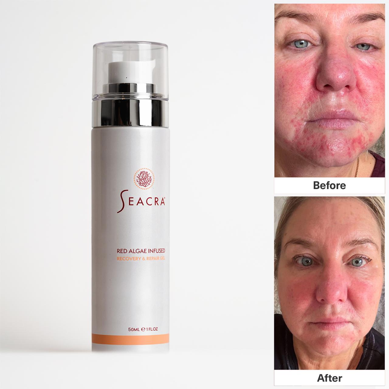 Seacra Red Algae Recovery and Repair Gel for rosacea-prone, red and reactive skin