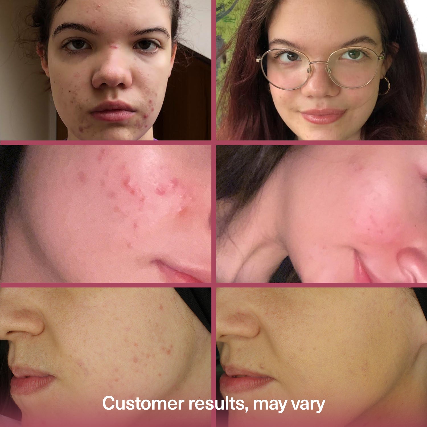 Before and after using Seacra Red Algae Gel for visible facial redness