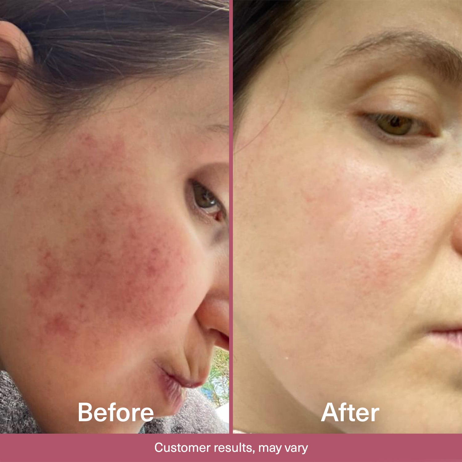 Customer before and after results with Seacra Gel for redness-prone sensitive skin