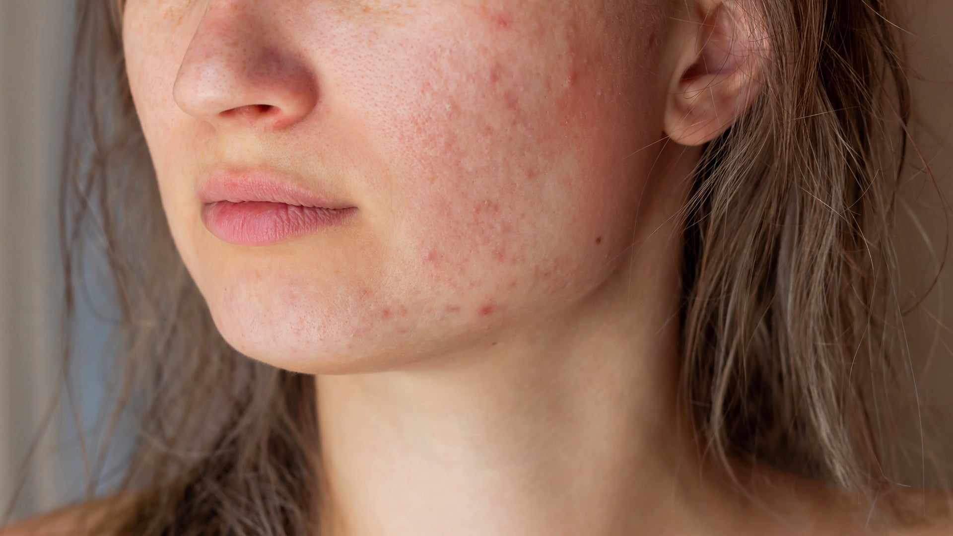 What are skin blemishes, and how do you get rid of them?