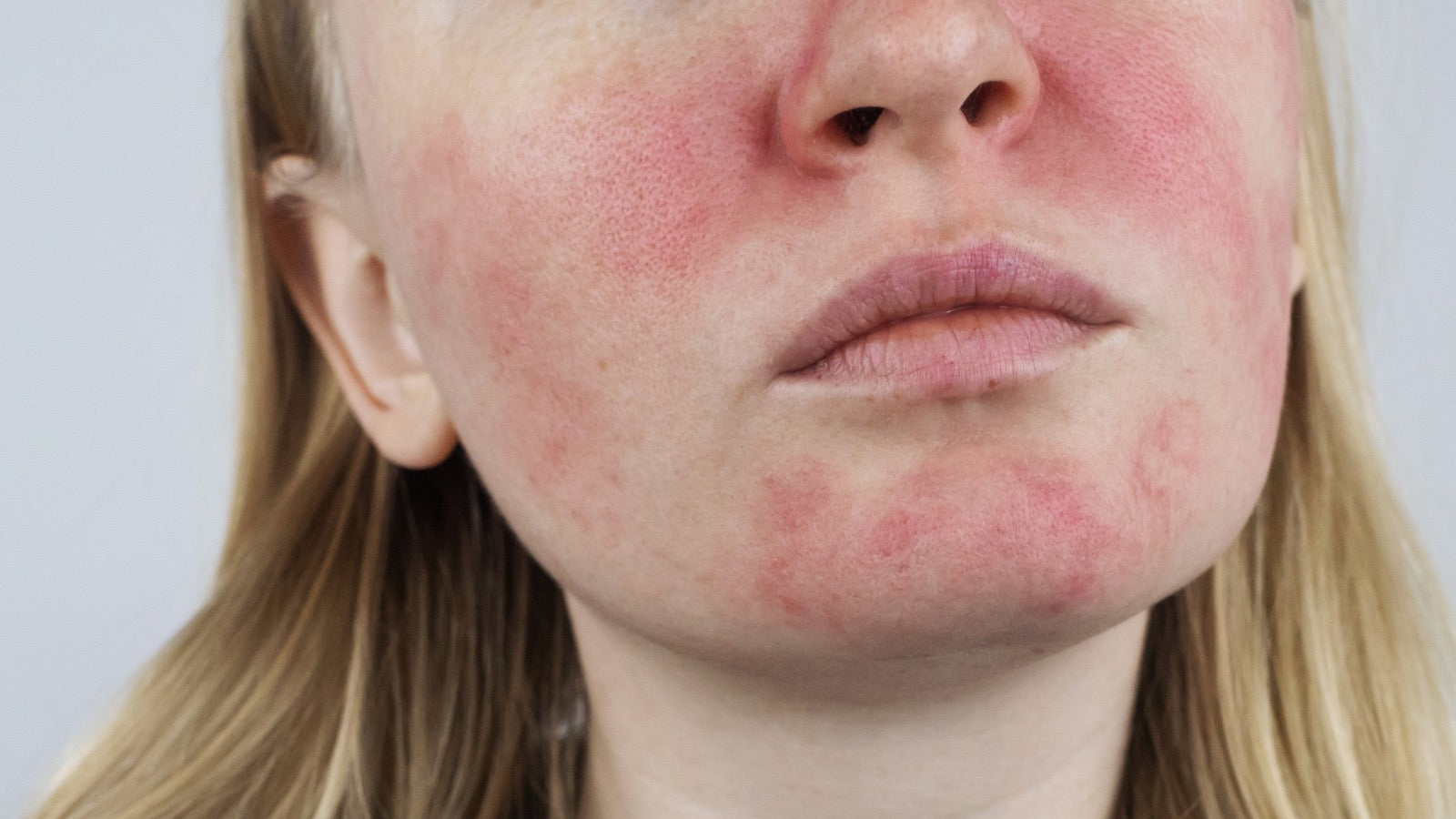 Rosacea and Acne Flare-Ups After the Holidays? Here’s How to Protect Your Skin