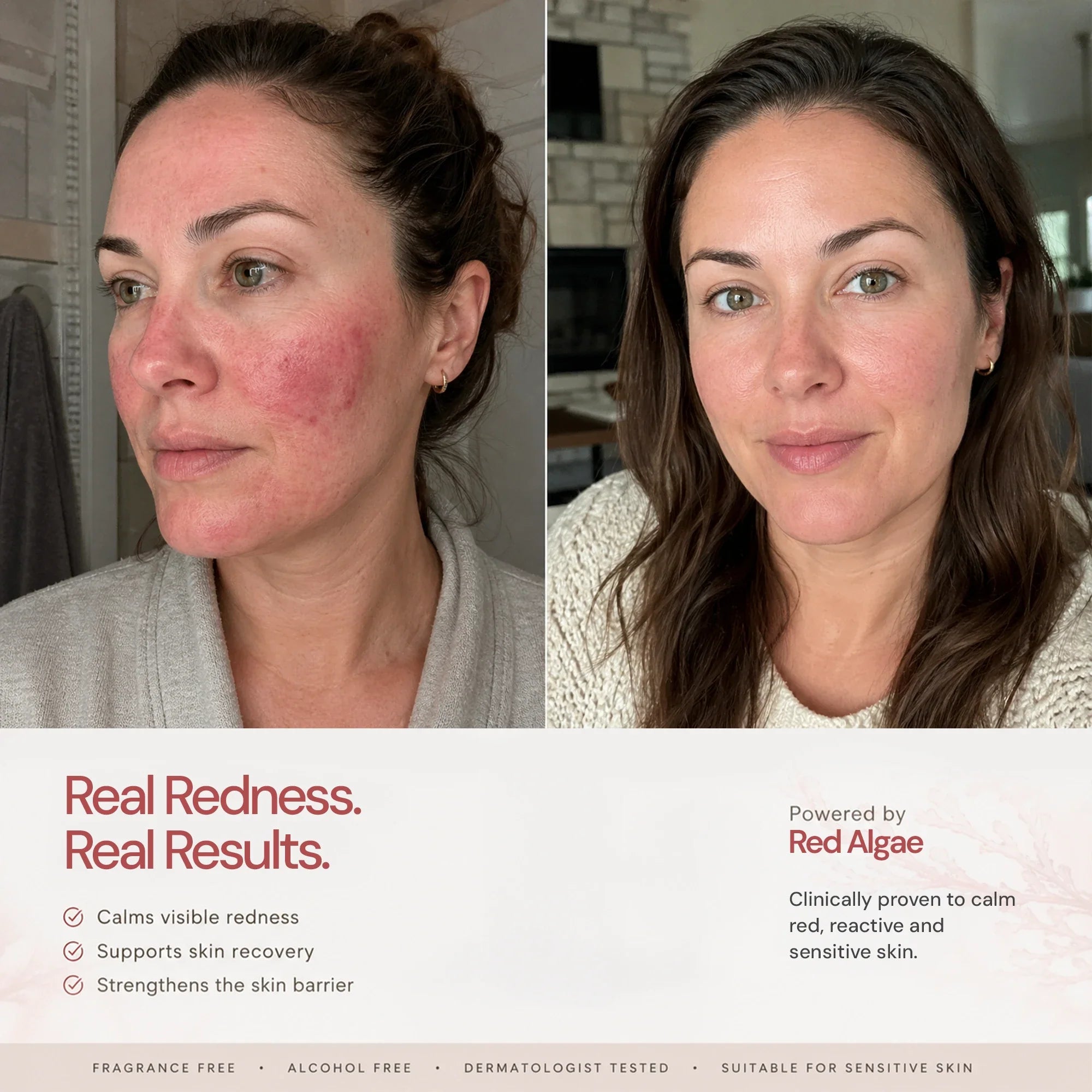 Red Algae Gel before and after — real results on rosacea-prone skin