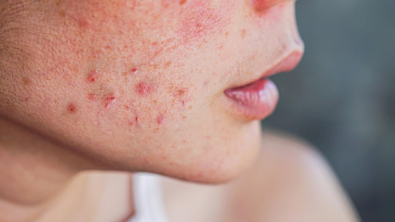 Acne in Adults: Why It’s Still a Problem and How to Tackle It