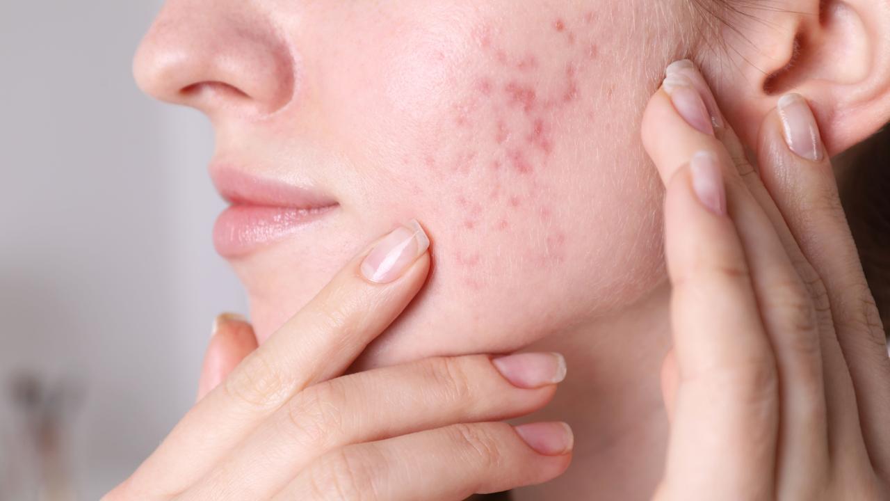 From Stubborn Acne to Rosacea: Why Natural Skincare Works Best – Seacra Skincare