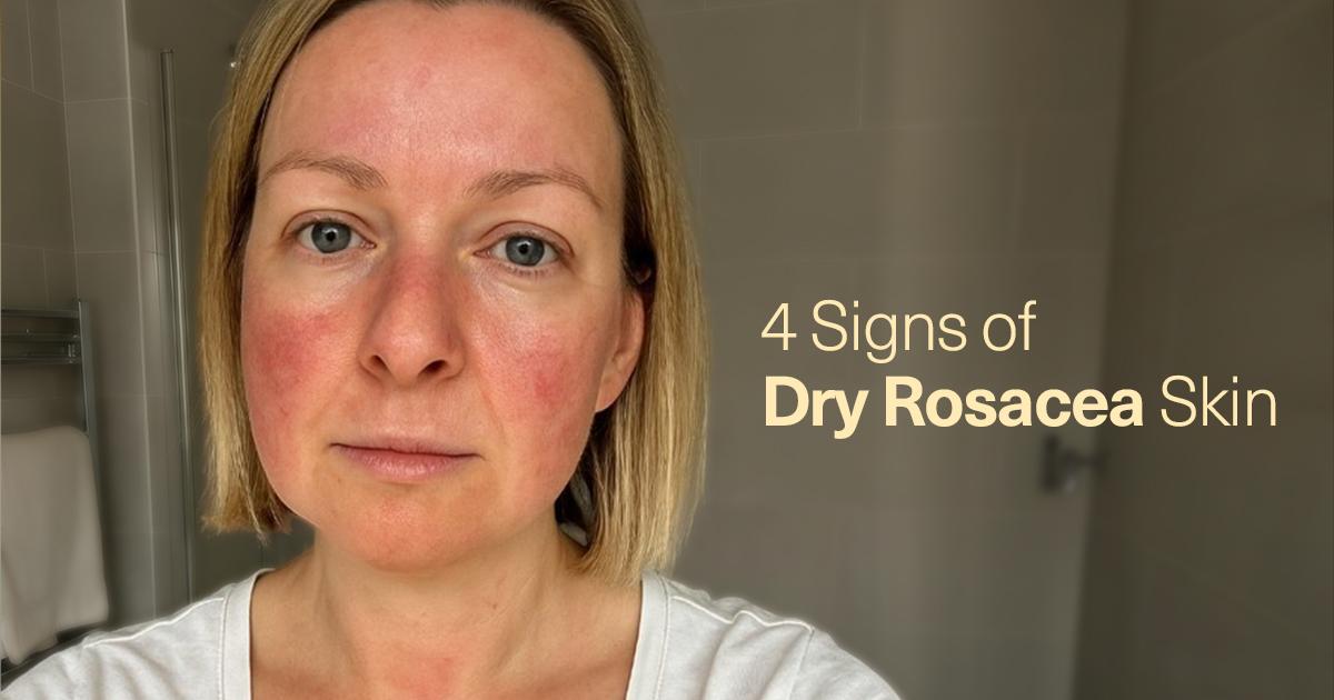 Signs of Dry Rosacea Skin (According to a Skincare Expert & Dermatologist)