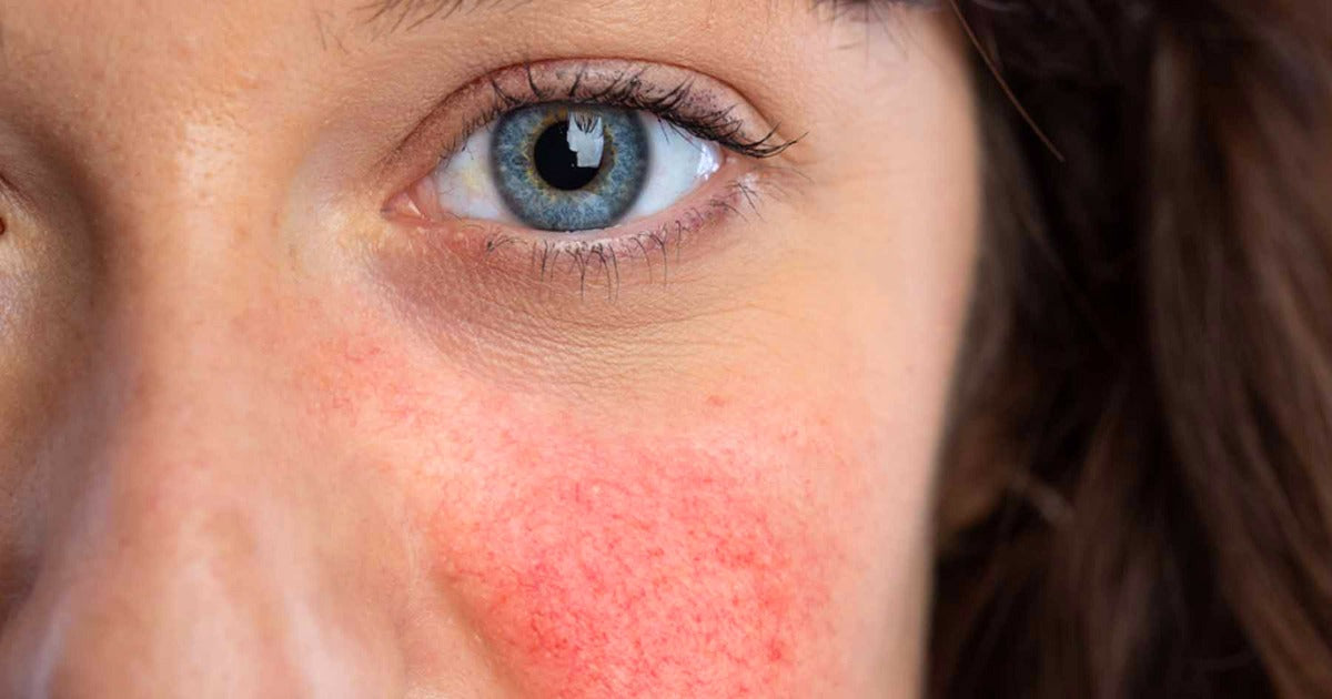 How to Reduce Redness on Your Face—Fast & Safely