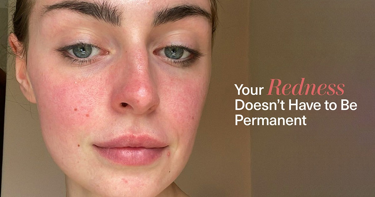 Close-up of calm, even-toned cheeks after reducing redness with a gentle Seacra routine