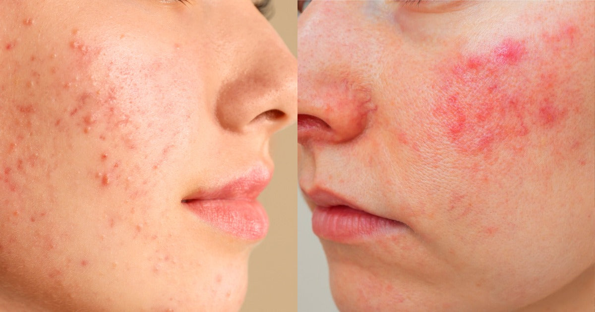 Rosacea and Blemishes: How to Reduce Redness and Calm Sensitive Skin