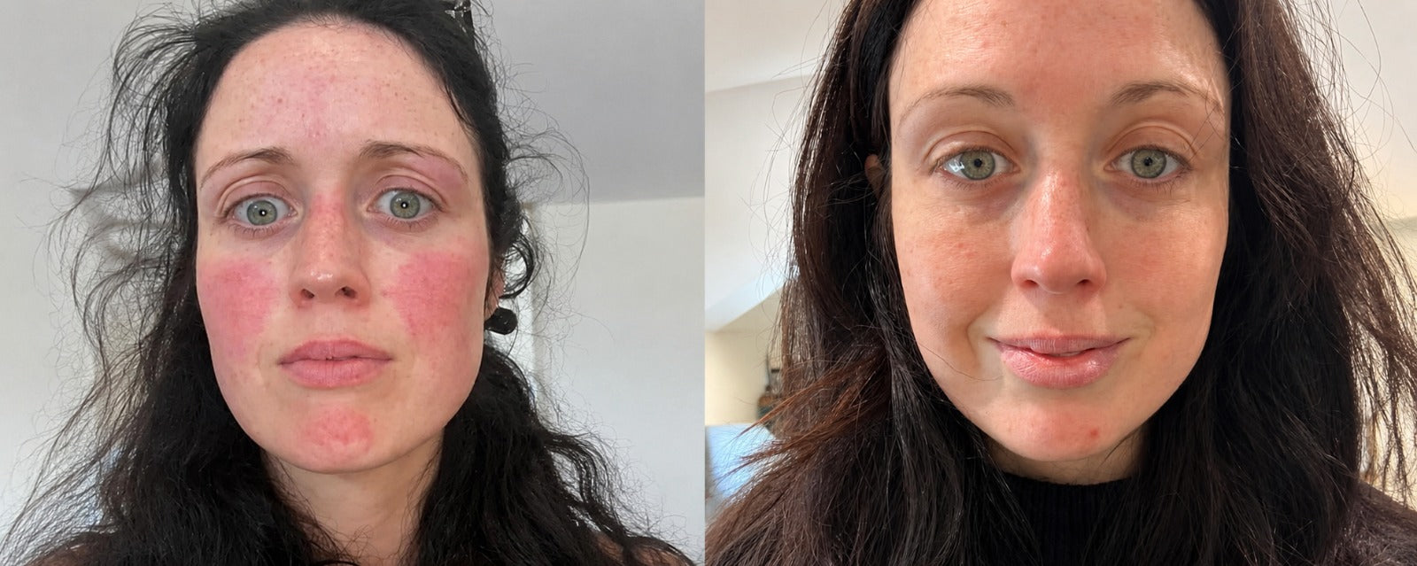Why Is My Face Always Red? 7 Signs It Might Be More Than Just Sensitive Skin