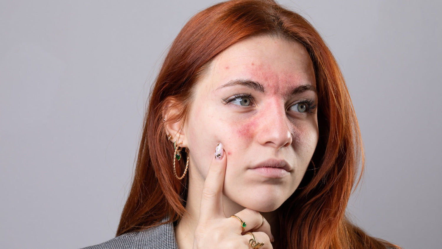 How to Treat Eczema on Face Naturally: 9 Remedies That Actually Work