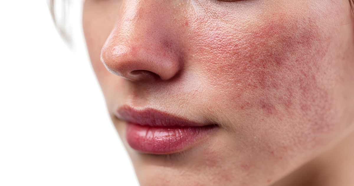 Why Does My Face Get So Red in Summer? Here's What's Really Happening to Your Skin