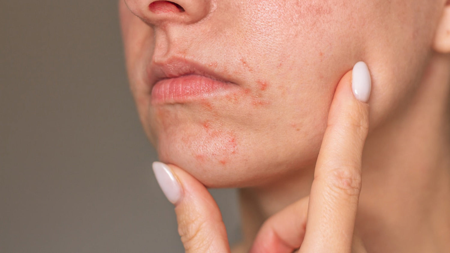 Dermatitis in Summer: Why Your Skin May Flare Up and How to Keep It Calm
