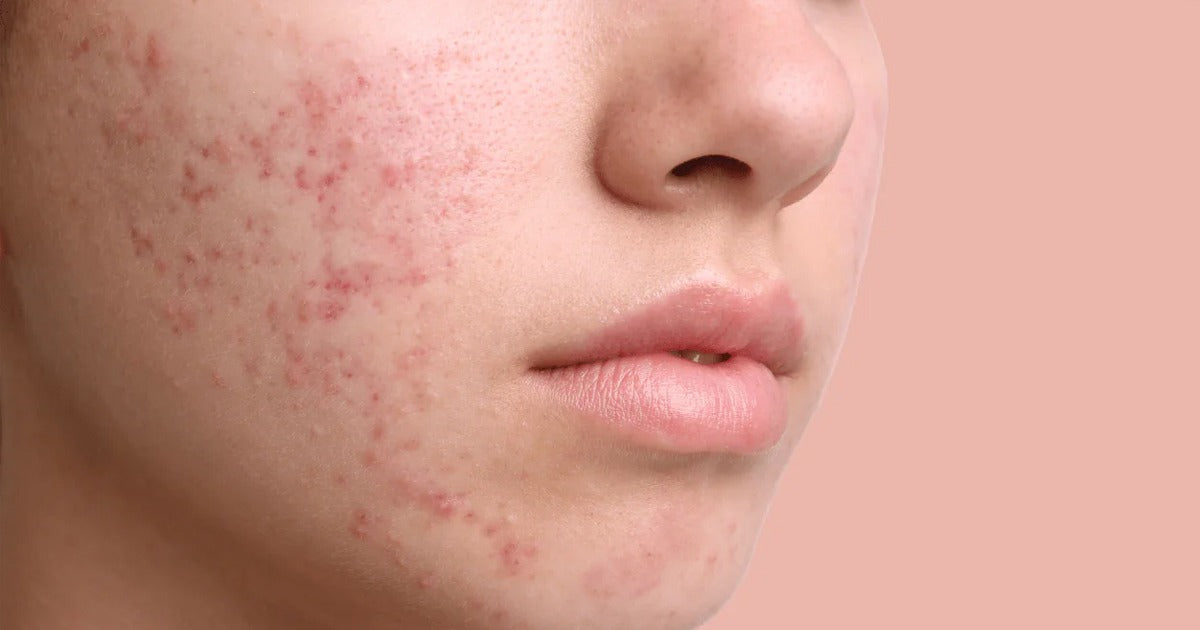 Is It Acne - or Is Your Skin Barrier Overwhelmed? How to Understand Summer Breakouts