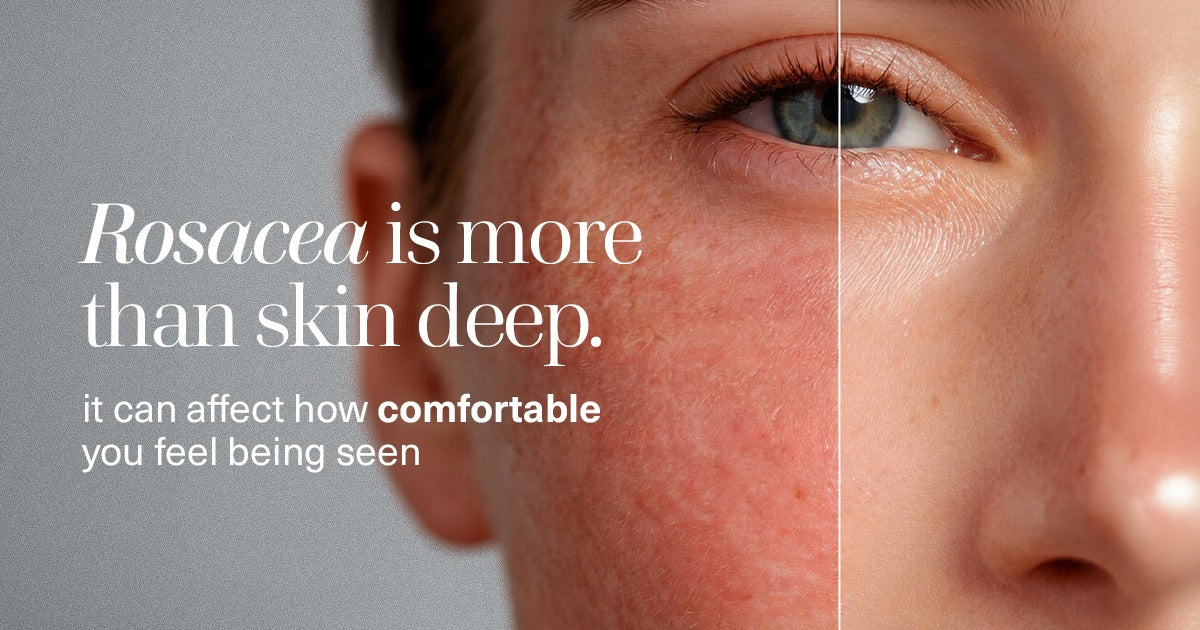 Rosacea Is More Than Skin Deep: The Emotional Impact of Facial Redness