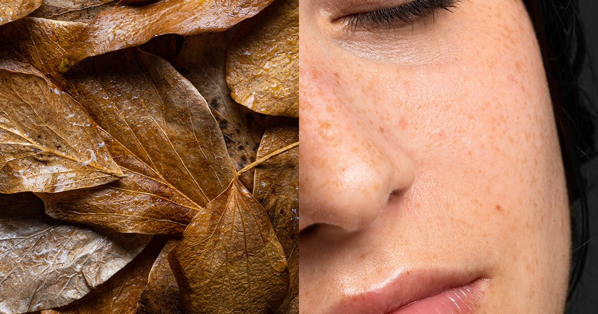 Why Does Rosacea Flare Up in Autumn?