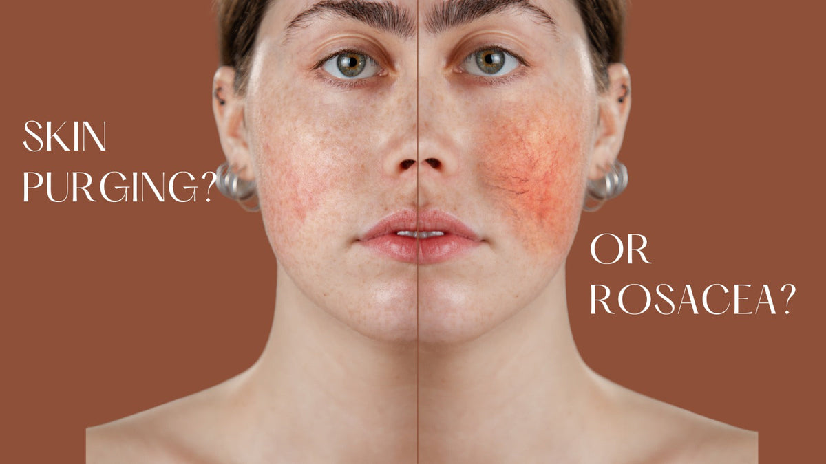 Purging, Irritation or a Rosacea Flare? How to Tell the Difference