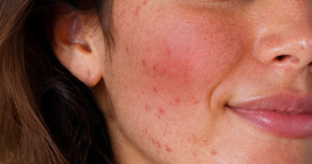 The Skin Microbiome and Rosacea: What Does the Science Actually Say?