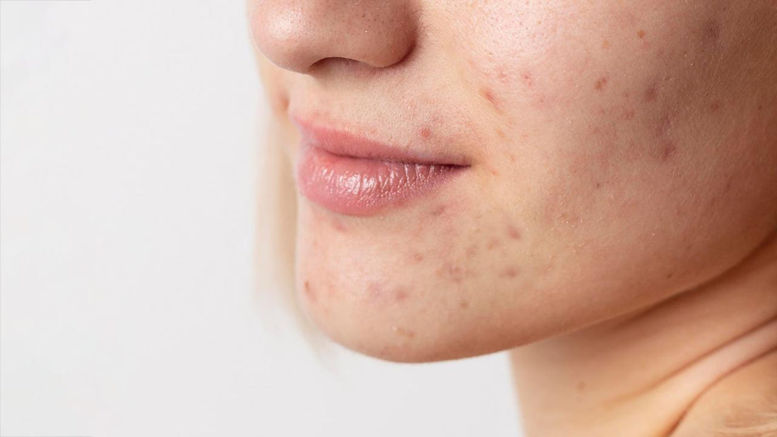 Understanding Acne: Causes, Types, and Treatment – Seacra Skincare