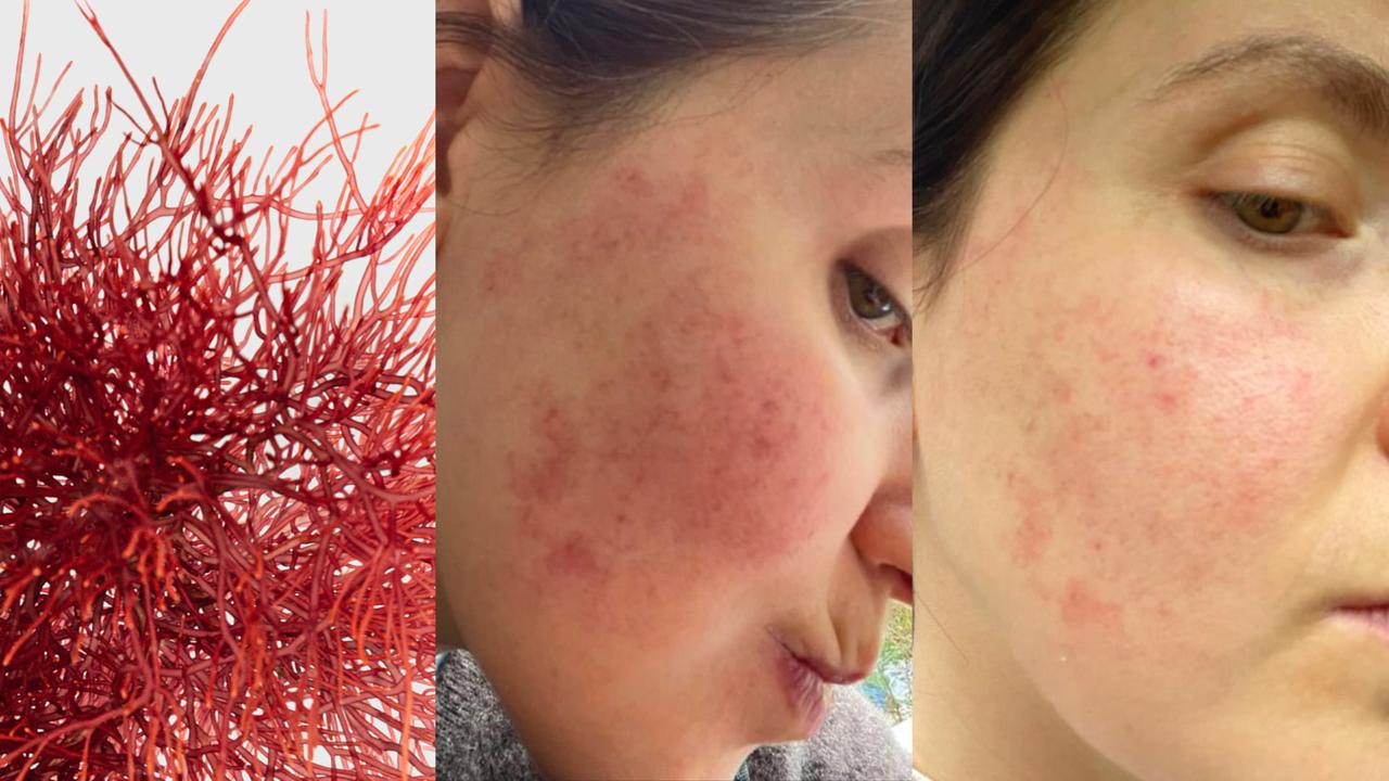 Understanding Rosacea: Causes, Symptoms, and How to Manage It Naturally with Red Algae