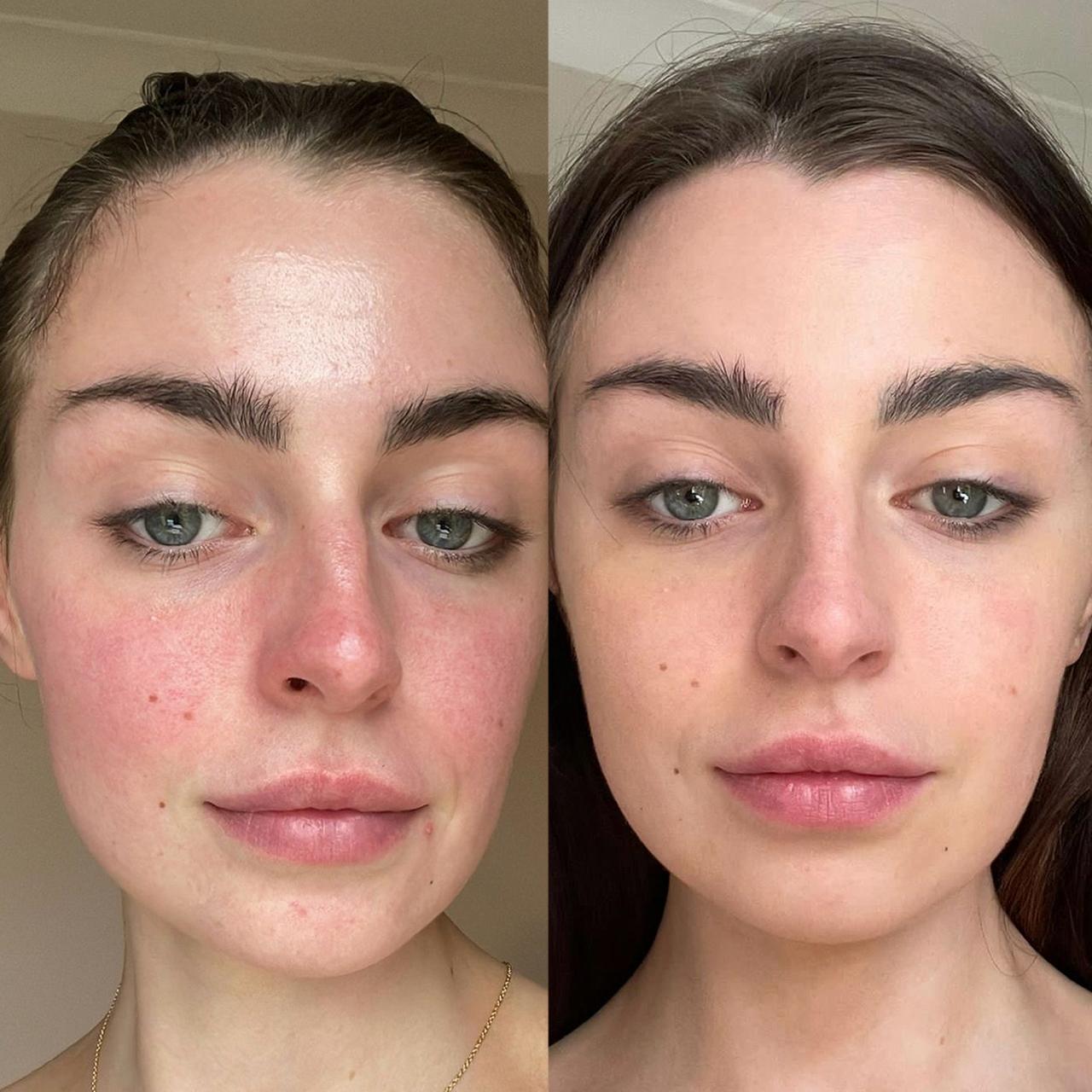 How to Reduce Redness on Face Quickly