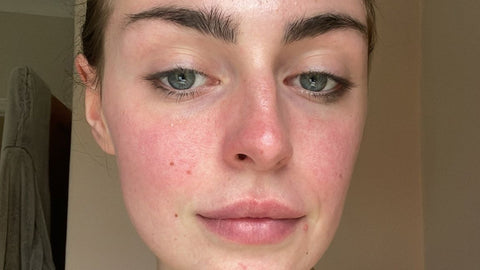 Redness-prone skin before Seacra