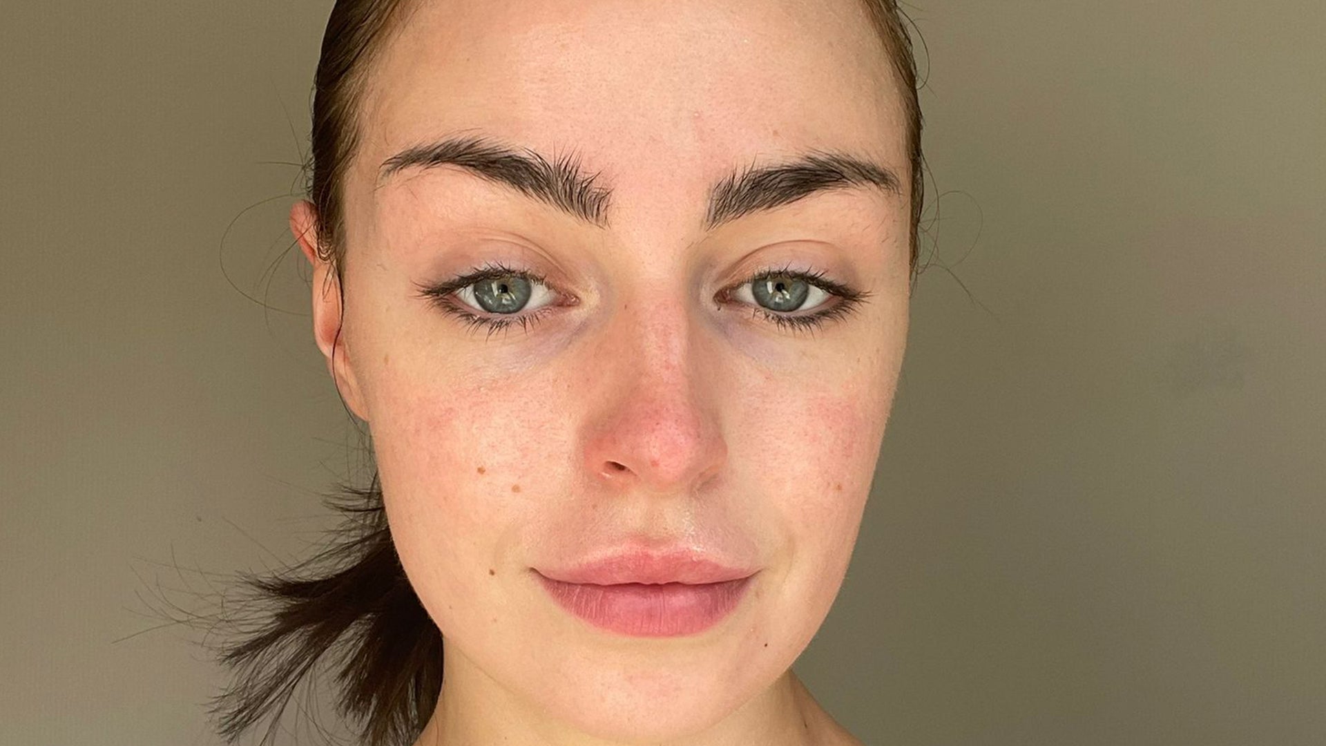 Redness-prone skin after month 2 using Seacra Red Algae Gel