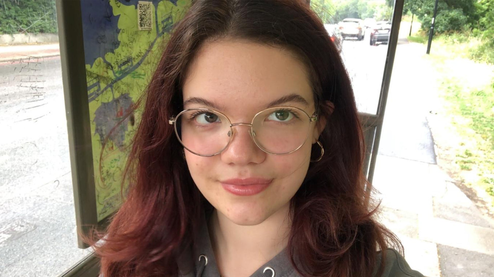 Acne and breakout-prone skin after month 3 using Seacra Red Algae Gel