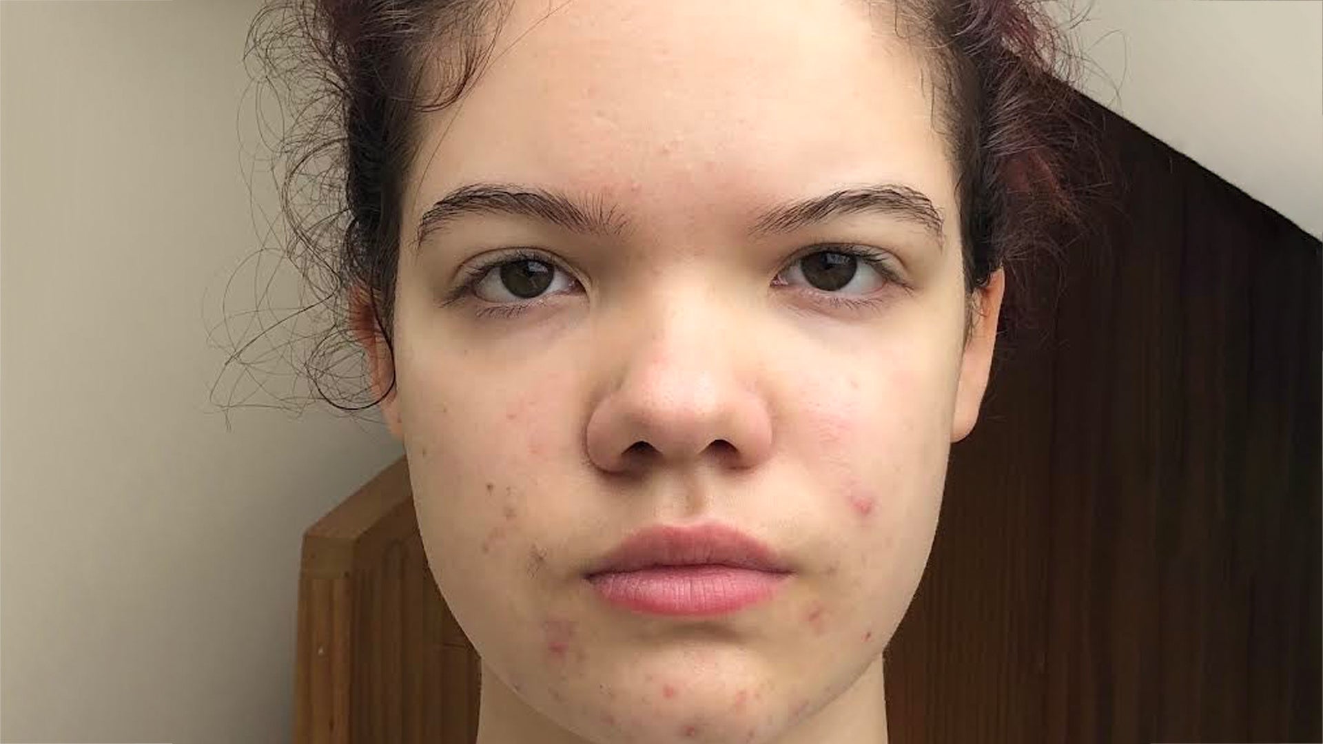 Acne and breakout-prone skin after month 2 using Seacra Red Algae Gel