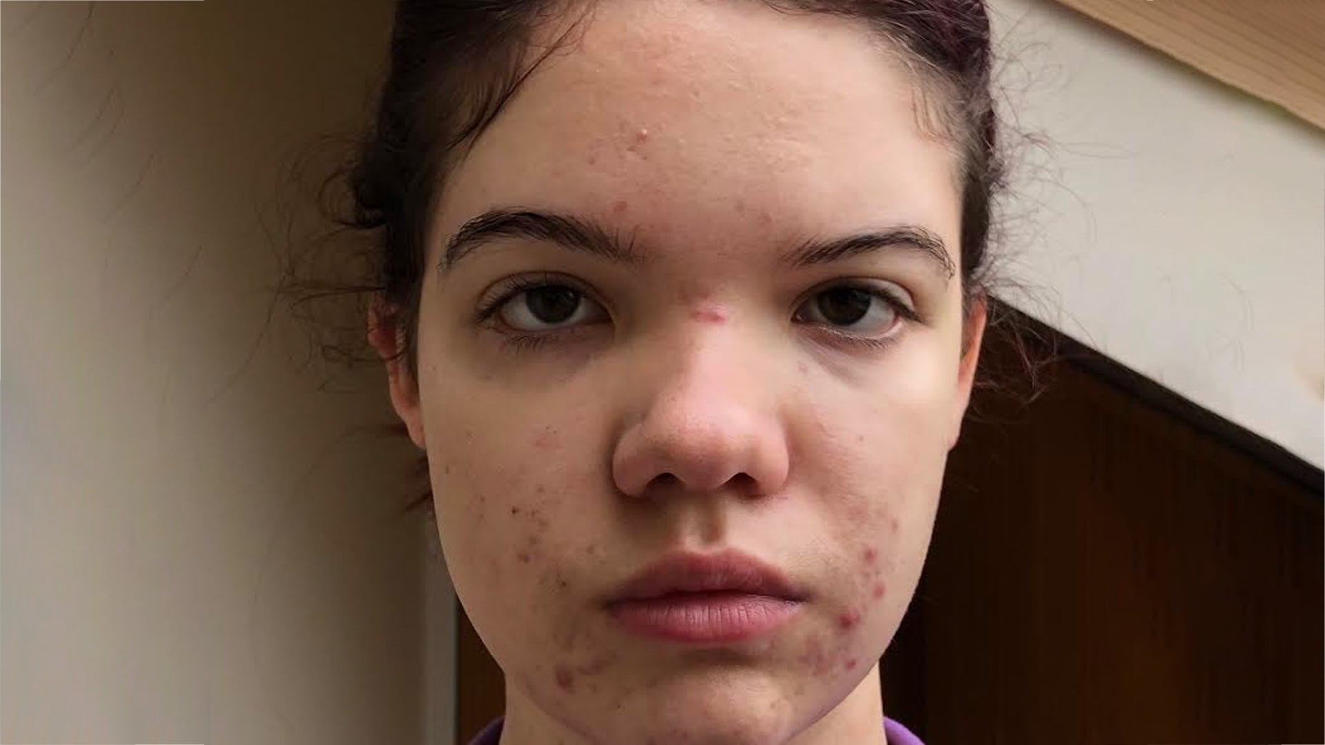 Acne and breakout-prone skin after month 1 using Seacra Red Algae Gel