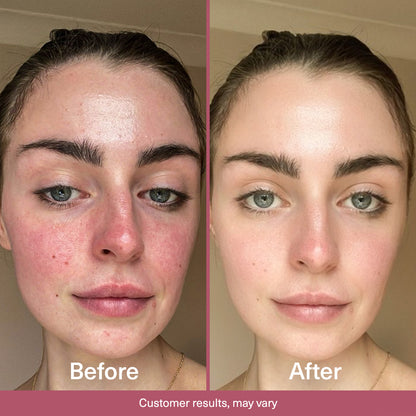 Before and after Seacra Red Algae Gel showing calmer-looking reactive skin