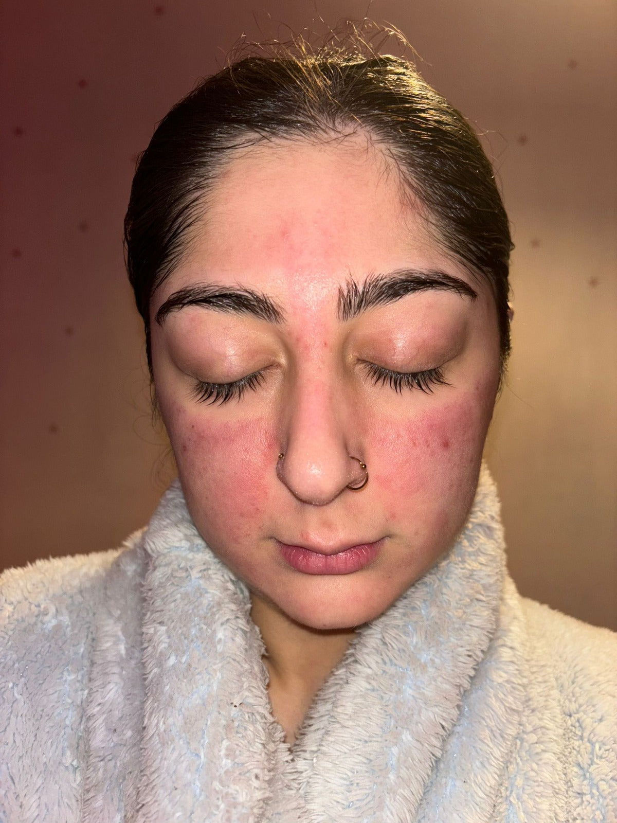 Rosacea-prone skin after month 1 using Seacra Red Algae Gel