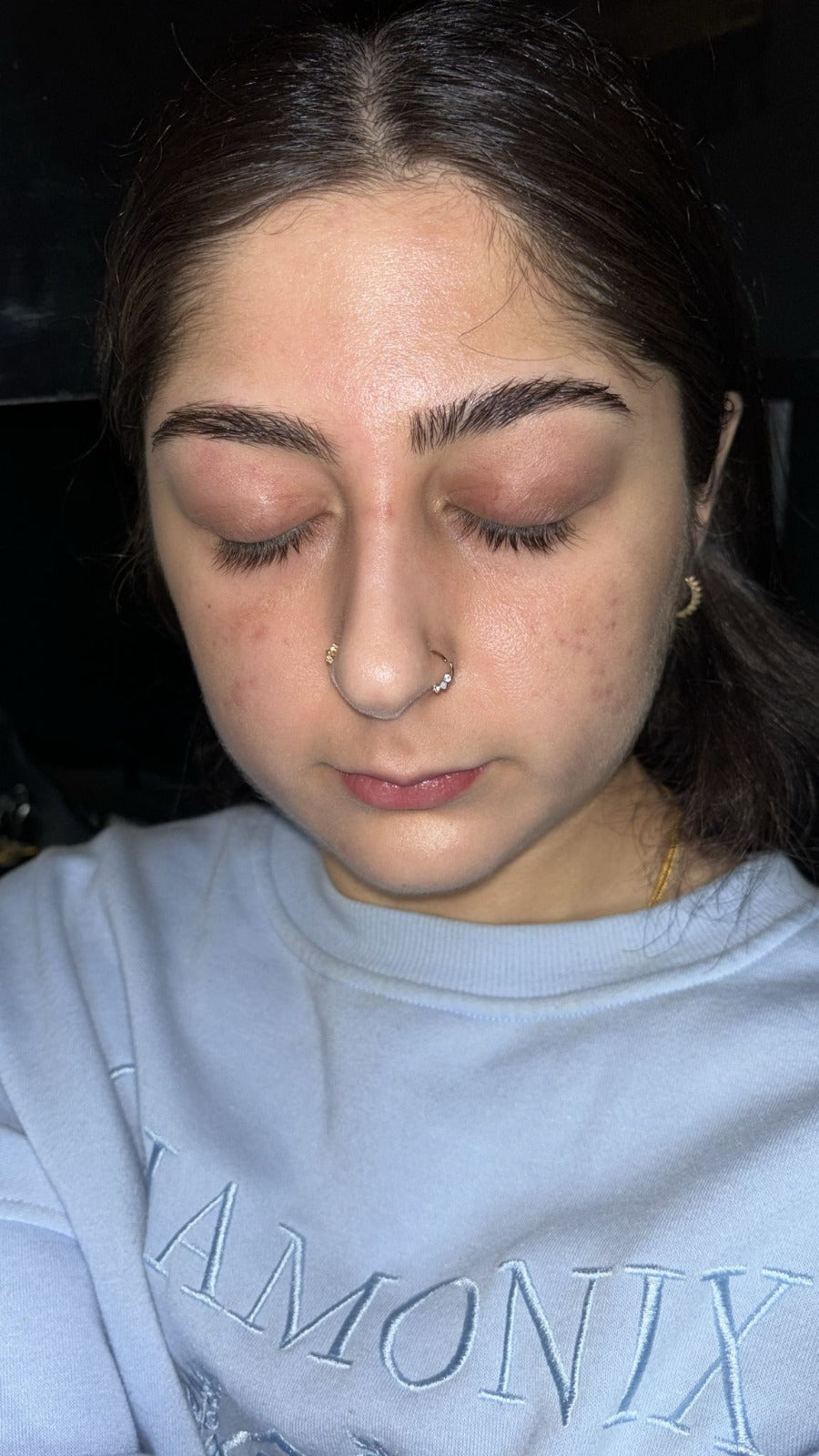 Rosacea-prone skin after month 2 using Seacra Red Algae Gel