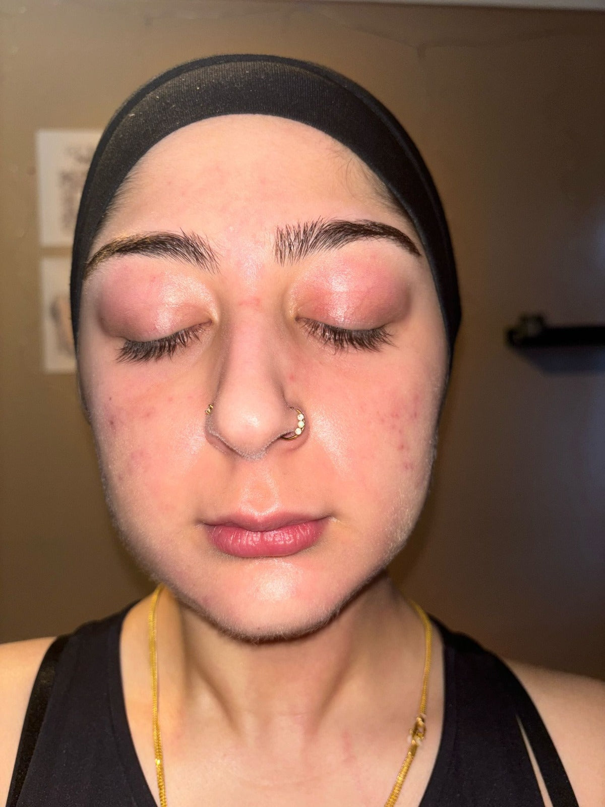 Rosacea-prone skin after month 3 using Seacra Red Algae Gel