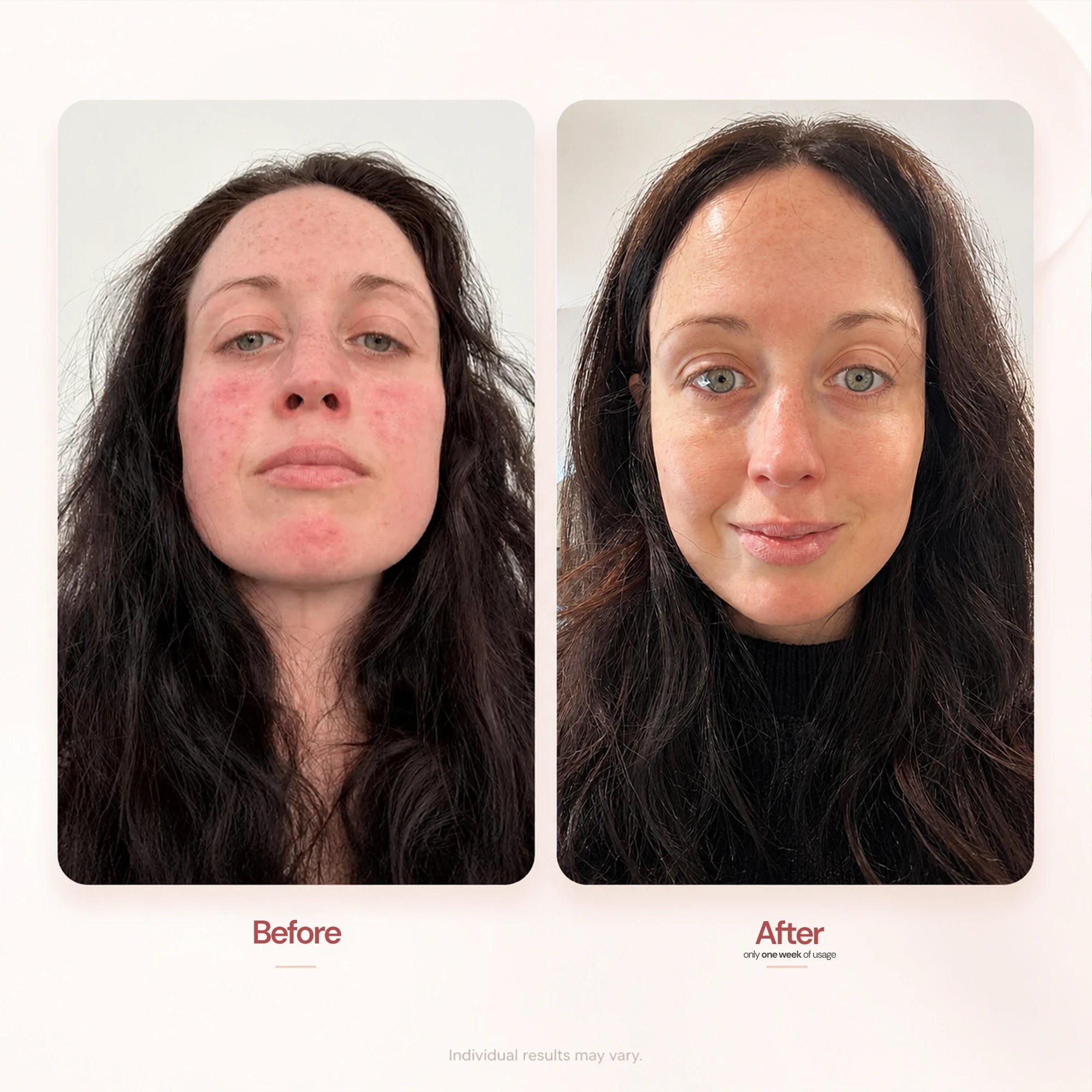 Seacra Red Algae Gel made for visible redness rosacea-prone skin sensitivity and irritation